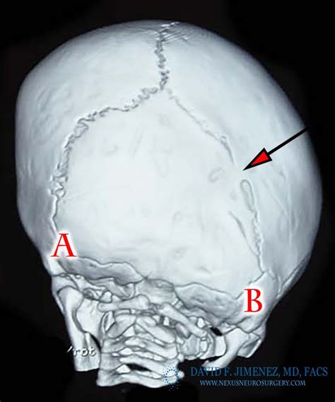 Lambdoid Synostosis Facts and Photos | Craniosynostosis