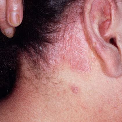 Symptoms And Treatment Of Scalp Psoriasis - How To Treat Scalp ...