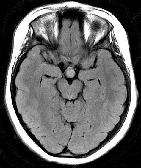 Hypothalamic Hamartoma, MRI - Stock Image - C030/6377 - Science Photo ...