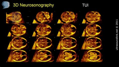 The 12 Weeks Scan: 3D and 4D Ultrasound - YouTube