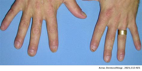 Acrodermatitis continua of Hallopeau and Koebner’s Phenomenon | Actas Dermo-Sifiliográficas