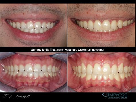 Receding Gums Surgery Before And After