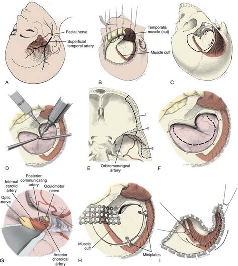 Surgical Approaches to Intracranial Aneurysms | Neupsy Key