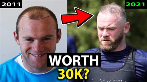 Wayne Rooney 10 Years after his 30k Hair Transplant(s). What Happened ...