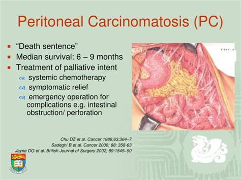 PPT - Management of Peritoneal Carcinomatosis in Colorectal Cancer PowerPoint Presentation - ID ...