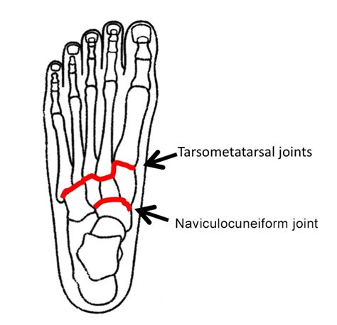 Midfoot Arthritis Treatment in Dubai - Dr K P Meda