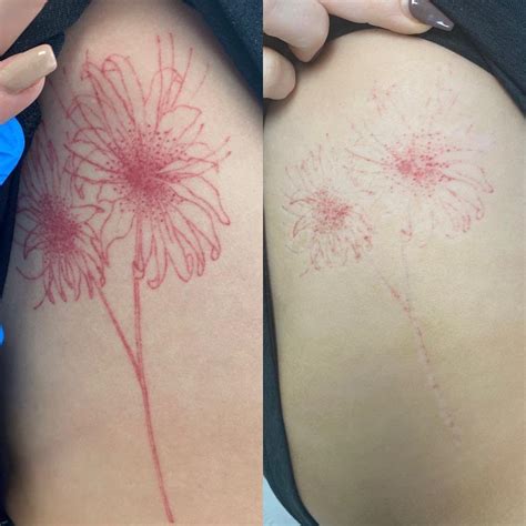 Can you remove red ink from tattoos? - Laser Club