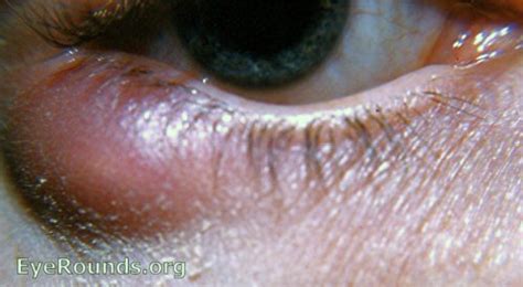 Subsiding acute meibomianitis going into the chalazion stage. EyeRounds.org: Online Ophthalmic Atlas