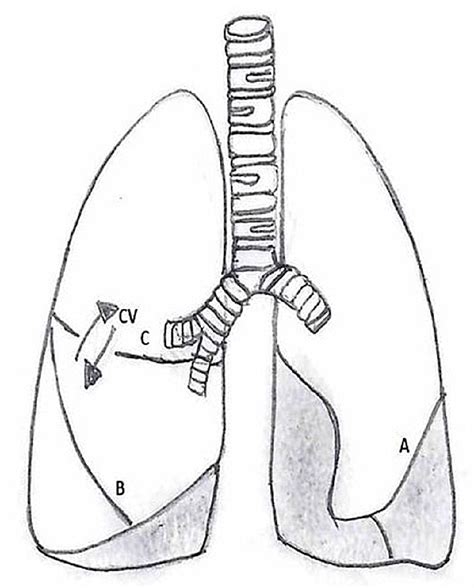 Variations in Pulmonary Fissure: A Source of Collateral Ventilation and ...