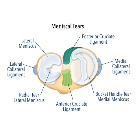 Meniscus Tear Treatment | Meniscus Tear Surgery