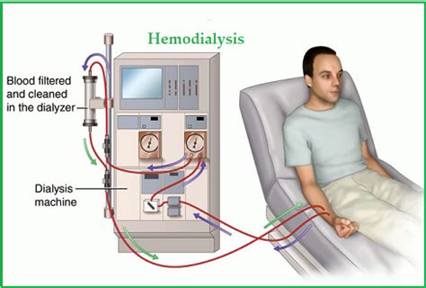 Hemodialysis Nursing Care Plan | Nurseonlineph | November 2014 NLE Results