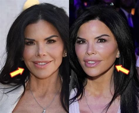 Lauren Sanchez Plastic Surgery: Before and After | PlasticSurgeryInsights.com