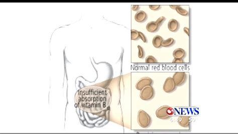 Pernicious Anemia | kiiitv.com