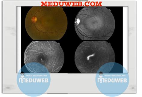 CENTRAL SEROUS CHORIORETINOPATHY (CSCR) - Meduweb