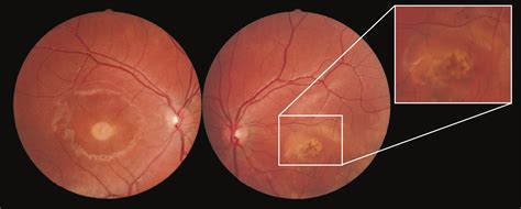 Autosomal Recessive Best Vitelliform Macular DystrophyReport of a Family and Management of Early ...