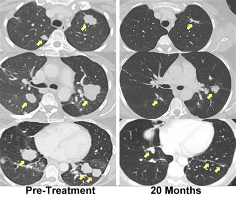 New Opportunities for Targeted Immunotherapy - National Cancer Institute