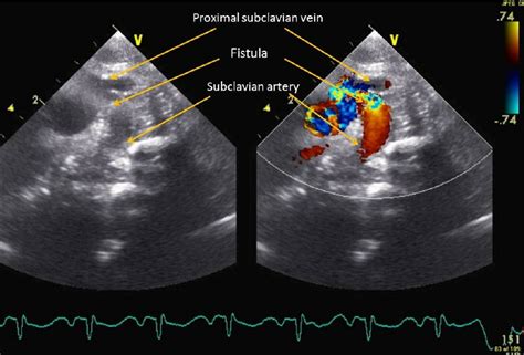 Echocardiogram Results