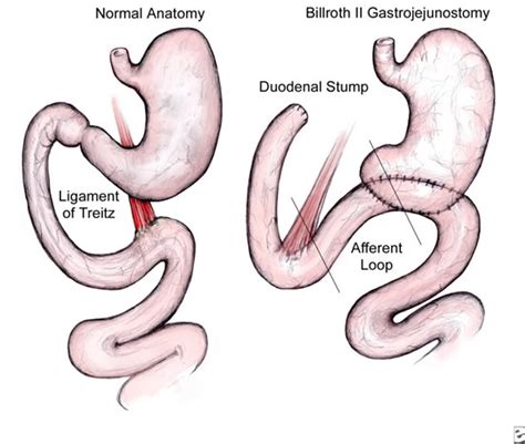 【gastroduodenostomy】什么意思_英语gastroduodenostomy的翻译_音标_读音_用法_例句_在线翻译_有道词典