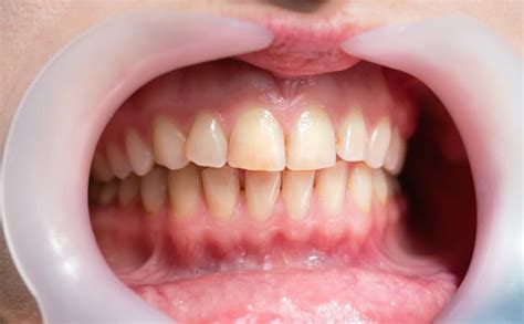 Causes of Periodontal Disease - Monmouth Dental Arts, Oakhurst, NJ