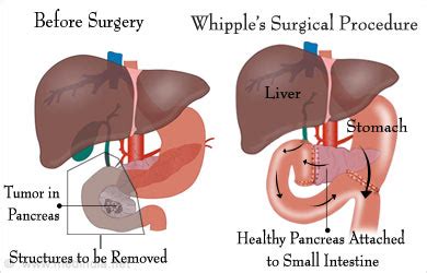 Pancreatectomy - Conditions, Types, Tests, Complications