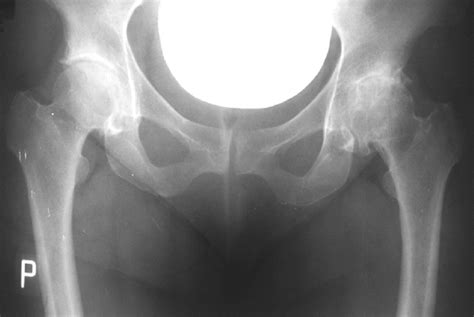 X-ray image of two hip joints. Kellgren and Lawrence grades: grade ...