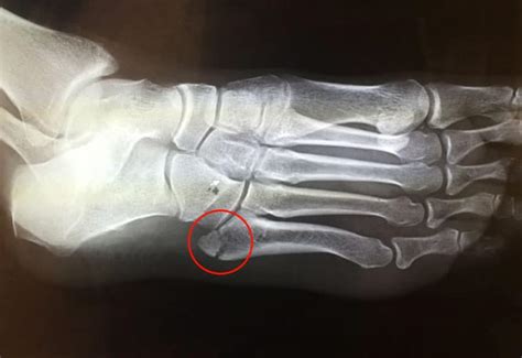 Fifth metatarsal fracture treatment and tips - bastaonweb