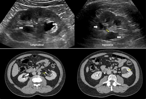 The Ultrasound Mimics of Hydronephrosis - Renal Fellow Network