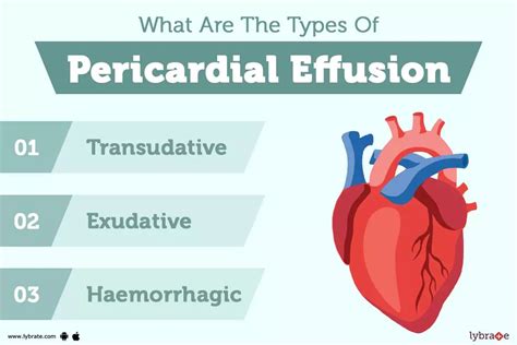 Pericardial Effusion: Causes, Symptoms, Treatment and Cost