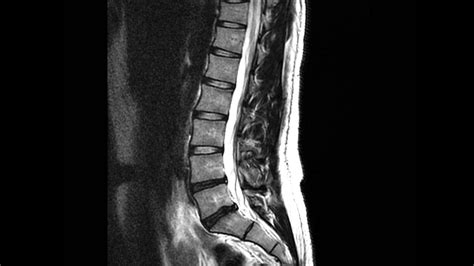 Lumber MRI Degenerative Disc Disease With Herniation... Please Help! - YouTube