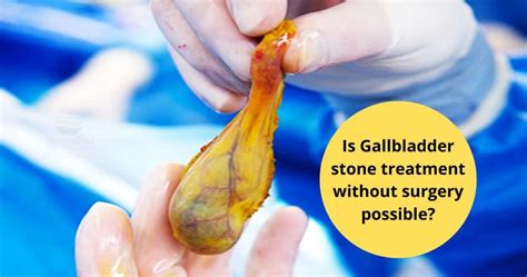 Is gallbladder stone treatment without surgery possible? - Dr Maran ...