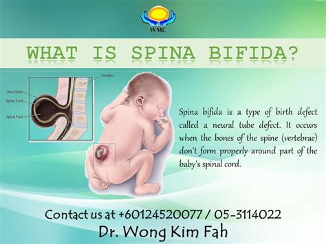 Understanding Spina Bifida: Causes, Symptoms, and Treatments