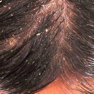 Ask Rogelio - What Causes Dandruff in Men? - The Lifestyle Blog for ...