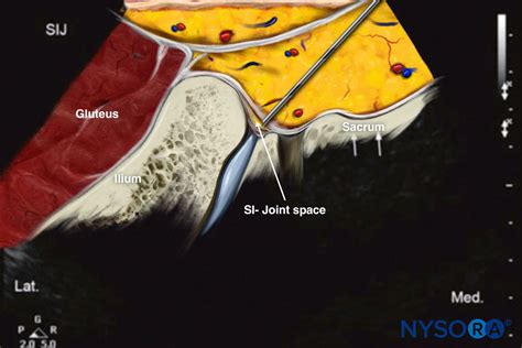 Ultrasound-Guided Sacroiliac Joint Injection - NYSORA