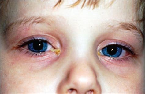 6 Things to Know About Conjunctivitis in Children (pink eye) – Things ...