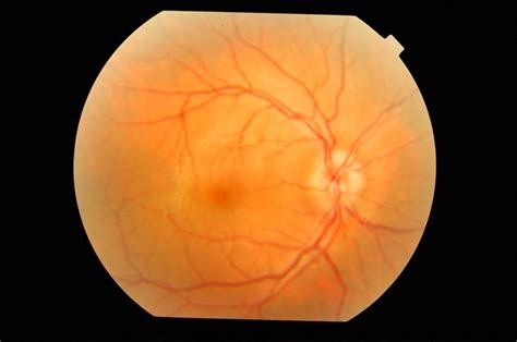 Posterior Scleritis Atypical - Retina Image Bank