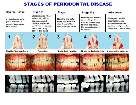 Periodontitis Stages Symptoms And Treatments Austin Laser Dentist | Hot Sex Picture