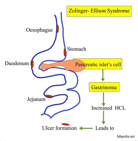 Zollinger-Ellison Syndrome, Gastrin, Gastrinoma – Labpedia.net