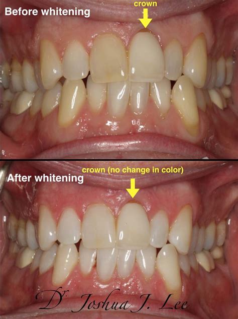 Zoom Whitening | Burlington Smiles Dental