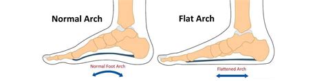 Understanding Pes Planus (Flat Feet) | Boyner Clinic