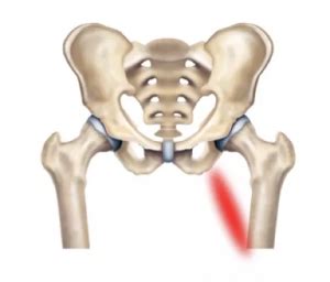 Adductor tendinopathy - City Hospital, Dehradun