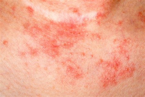 Eczema Causes, Symptoms, Diagnosis and Treatment - Natural Health News