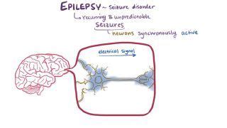 Catalepsy: What Is It, Causes, Signs, Symptoms, and More | Osmosis