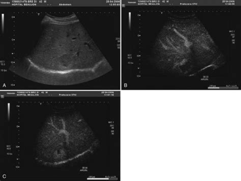 Liver Lipoma Ultrasound | Sitelip.org