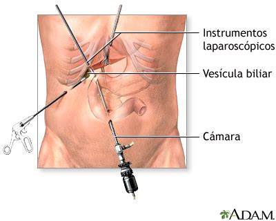 Colecistectomía - Serie—Incisión: MedlinePlus enciclopedia médica