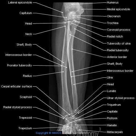 Radiography - Forearm : Radius, Ulna, Capitulum of humerus, Tuberosity of ulna, Radial ...