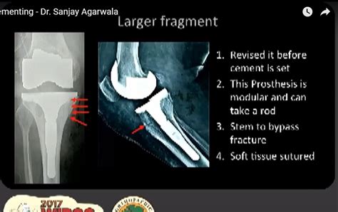 IntraOperative Periprosthetic fracture during Total Knee Replacement — OrthopaedicPrinciples.com