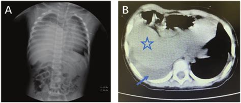 (A) Chest X-ray showing an obviously elevated right diaphragm combined... | Download Scientific ...