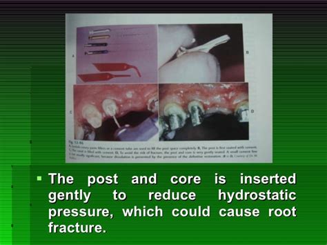 3. post retained crown-midterm3