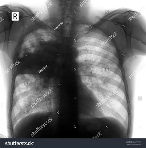 Xray Lungs Tuberculosis Lungs Negative Stock Photo 665399617 | Shutterstock