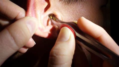 Manual Removal – The Ear Wax Removal Specialists UK